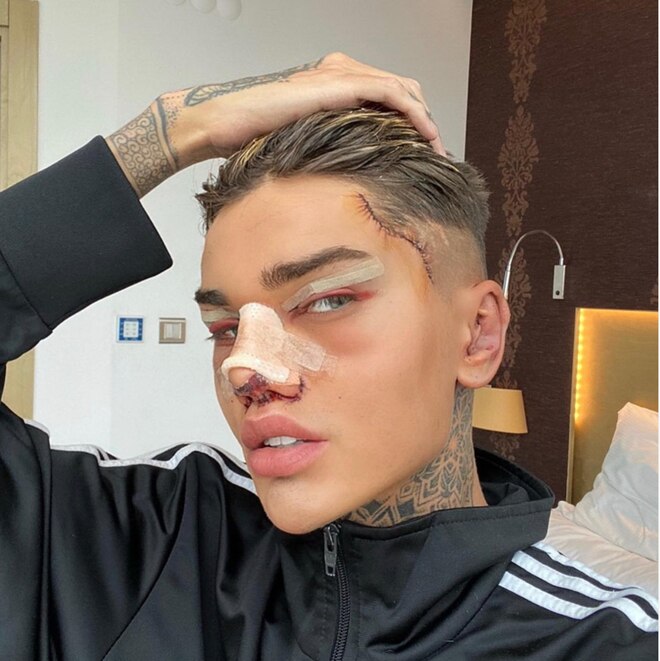 TikToker Says the Best Part of Plastic Surgery Is "Getting Content" TikToker Says the Best Part of Plastic Surgery Is